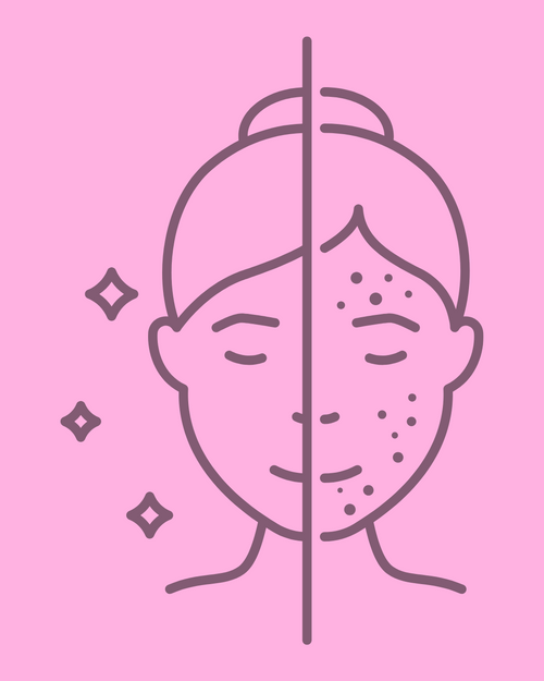Acne Facial Treatment 60 minutes